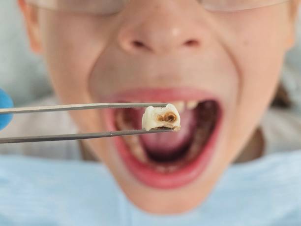 Best Emergency Treatment for Oral Infections in Ave Maria, FL